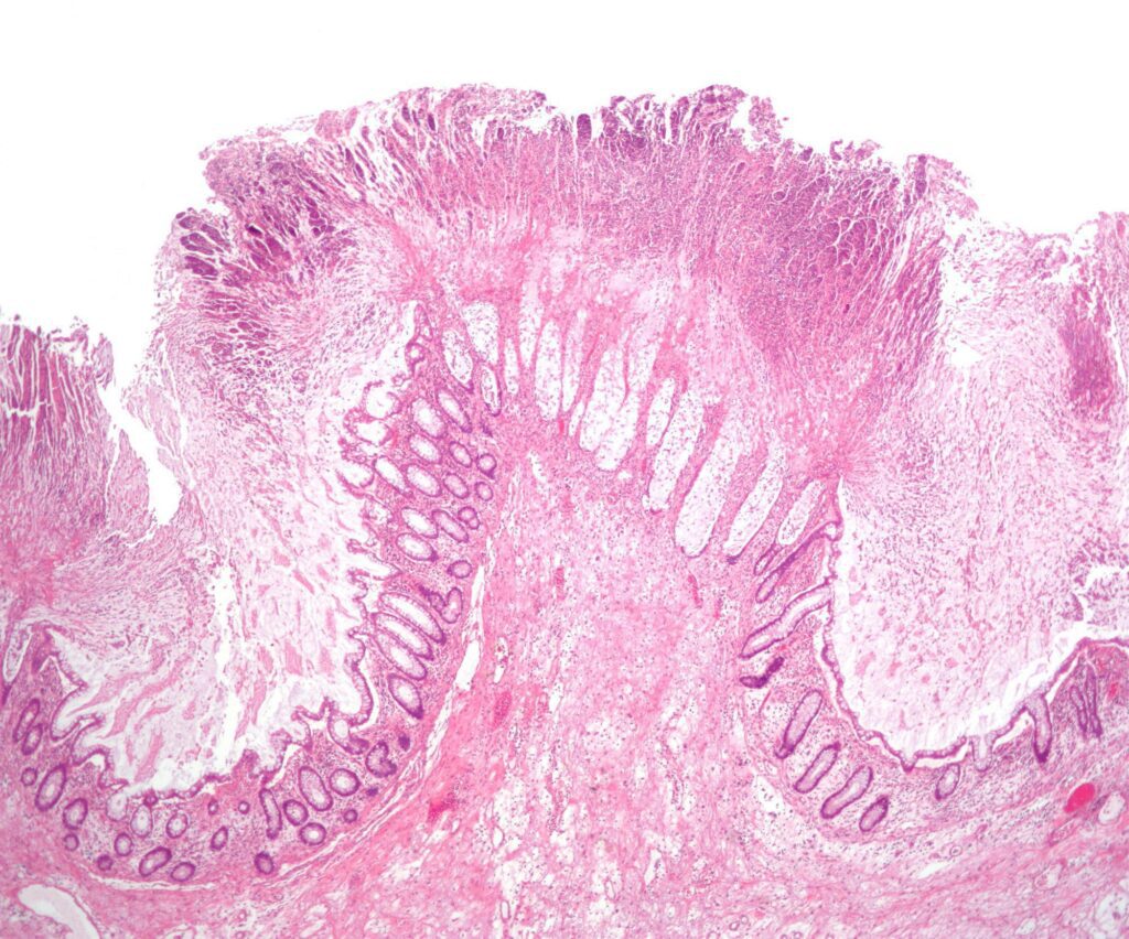 Micrograph of pseudomembranous colitis, an indication for colectomy