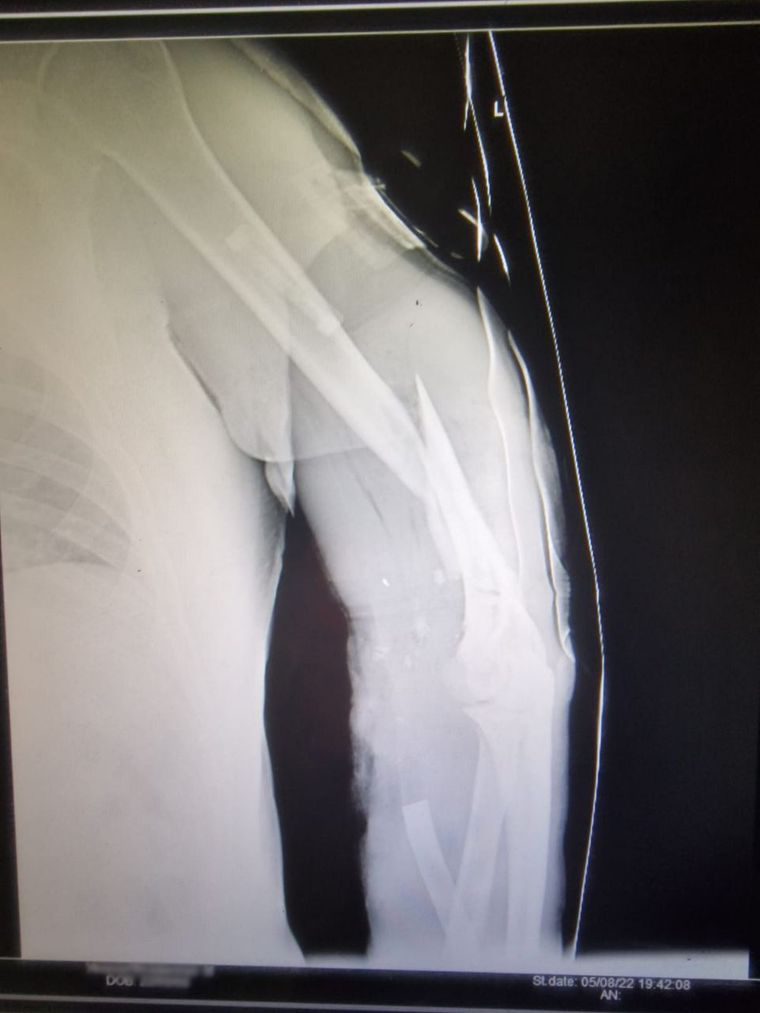 зламана рука рентген