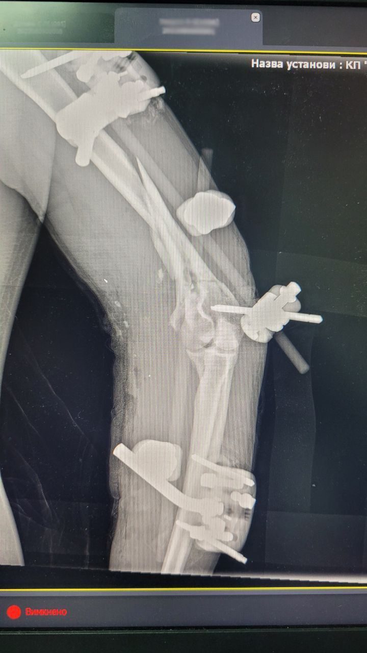рентген рука остеосинтез